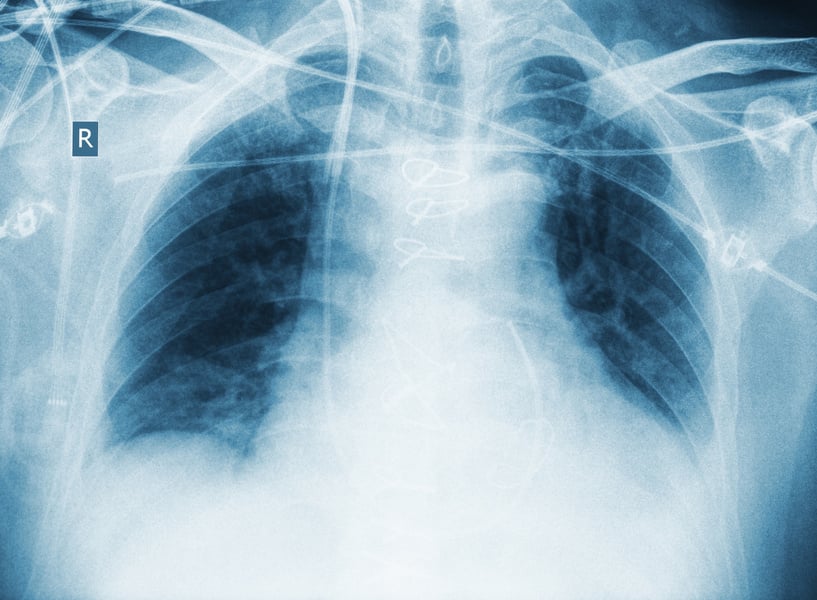 -Ray Image of Critically Ill Patient